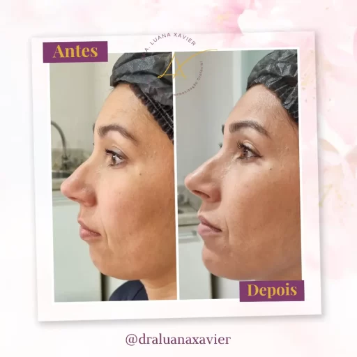 Dra Luana Xavier Antes e Depois (26) copy