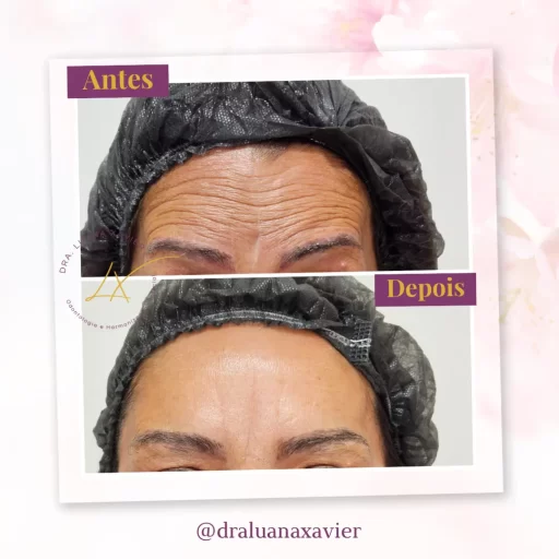 Dra Luana Xavier Antes e Depois (9) copy